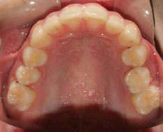 Teeth Upper