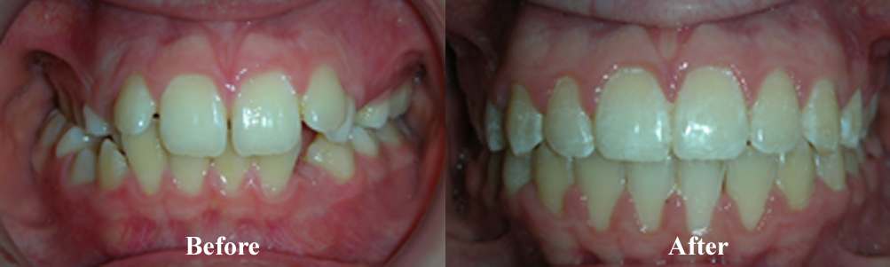Picture of a Crossbite Correction