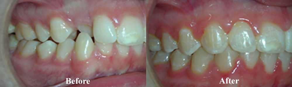 Picture of another Crossbite Correction