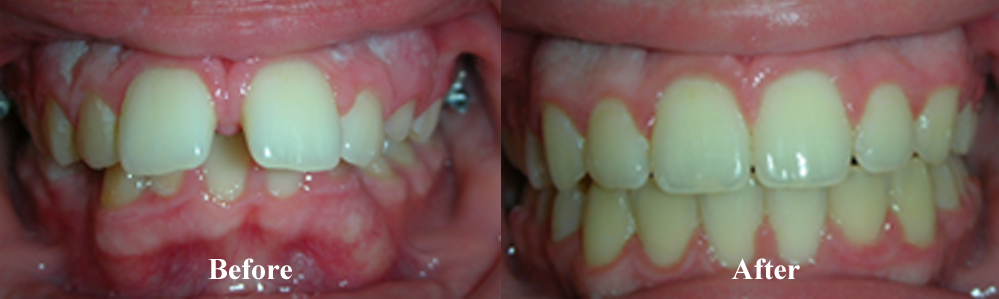 Picture of an Overbite Correction