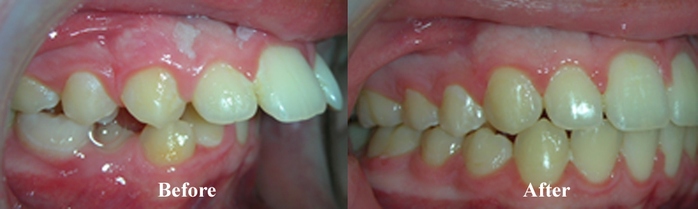 Picture of another Overbite Correction
