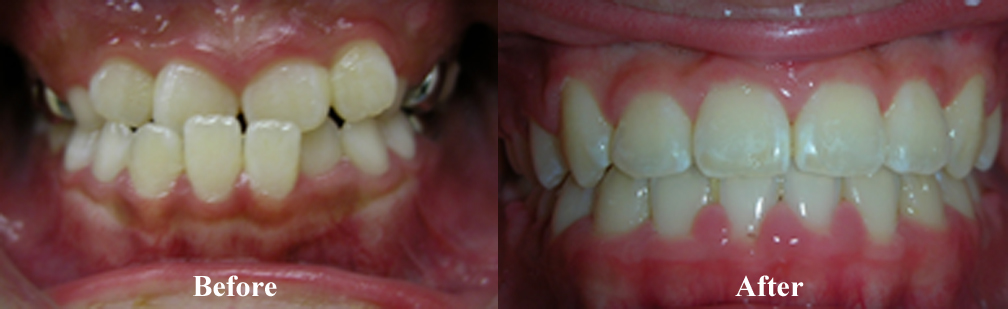 Picture of an Underbite Correction