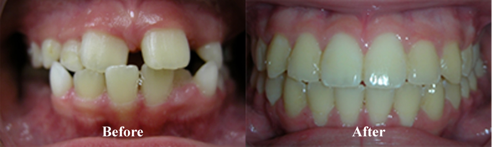 Picture of another Underbite Correction