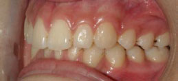 Teeth Left