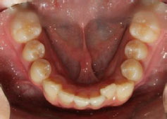 Teeth Lower